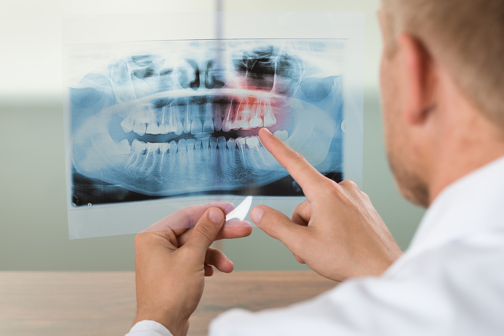 radiologia-dentale poco osso