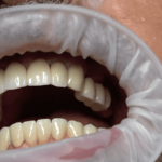 Impianti dentali poco osso evita innesti rialzi circolare senza gengiva